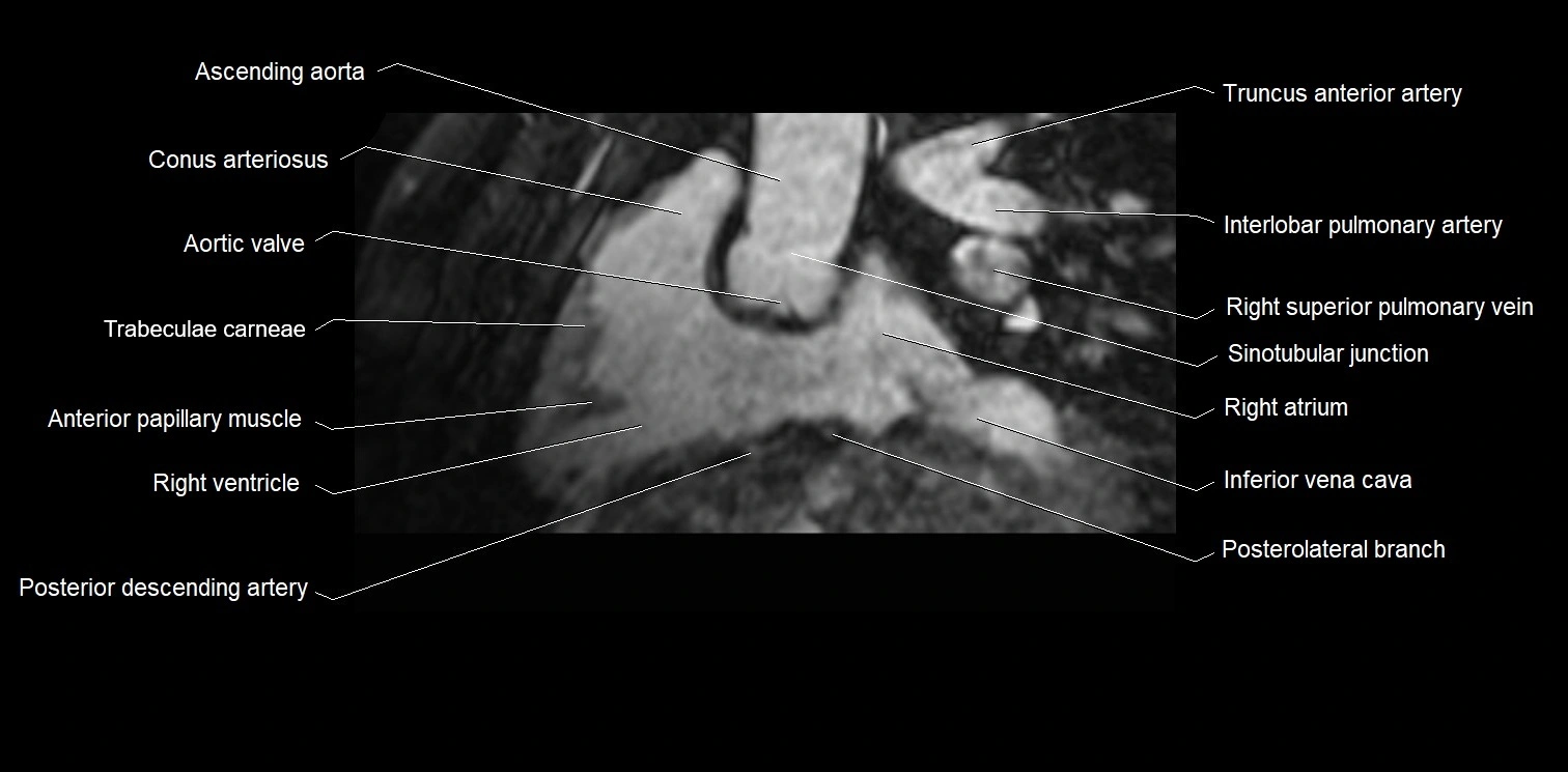 MRI heart and coronary arteries two chamber(sagittal)  anatomy image 15.webp